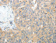 RAMP3 Antibody - Immunohistochemistry of paraffin-embedded Human thyroid cancer using RAMP3 Polyclonal Antibody at dilution of 1:40.