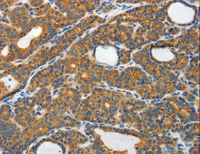 RAMP3 Antibody - Immunohistochemistry of paraffin-embedded Human thyroid cancer using RAMP3 Polyclonal Antibody at dilution of 1:40.