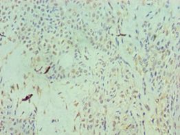 RAN Antibody - Immunohistochemistry of paraffin-embedded human breast cancer using antibody at 1:100 dilution.