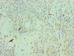 RAN Antibody - Immunohistochemistry of paraffin-embedded human breast cancer using RAN Antibody at dilution of 1:100