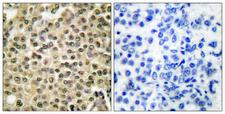 RAN Antibody - Peptide - + Immunohistochemical analysis of paraffin-embedded human breast carcinoma tissue using RAN antibody.