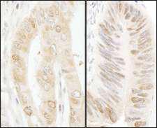 RANBP1 Antibody - Detection of Human RanBP1 by Immunohistochemistry. Sample: FFPE section of human lung carcinoma (left) and colon carcinoma (right). Antibody: Affinity purified rabbit anti-RanBP1 used at a dilution of 1:1000 (1 ug/ml). Detection: DAB.