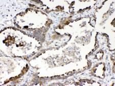 RANBP1 Antibody - IHC testing of FFPE human lung cancer tissue with RanBP1 antibody at 1ug/ml. Required HIER: steam section in pH6 citrate buffer for 20 min and allow to cool prior to testing.