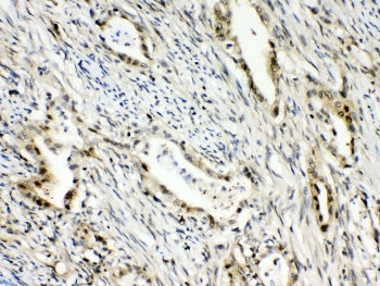 RANBP1 Antibody - IHC testing of FFPE human intestinal cancer tissue with RanBP1 antibody at 1ug/ml. Required HIER: steam section in pH6 citrate buffer for 20 min and allow to cool prior to testing.