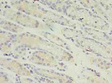 RANBP2 / TRP1 Antibody - Immunohistochemistry of paraffin-embedded human gastric cancer using antibody at dilution of 1:100.