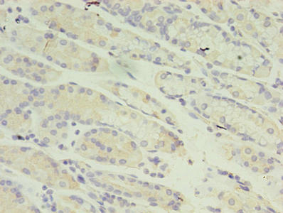 RANBP2 / TRP1 Antibody - Immunohistochemistry of paraffin-embedded human gastric cancer using RANBP2 Antibody at dilution of 1:100