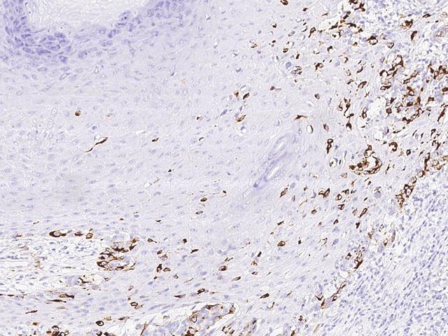 RANBP2 / TRP1 Antibody - Immunochemical staining of human TRP1 in human malignant melanoma with rabbit polyclonal antibody at 1:1000 dilution, formalin-fixed paraffin embedded sections.