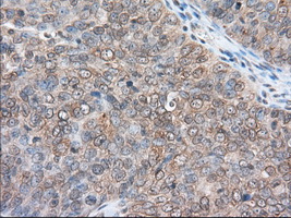 RANGAP1 Antibody - IHC of paraffin-embedded Adenocarcinoma of Human ovary tissue using anti-RANGAP1 mouse monoclonal antibody. (Dilution 1:50).