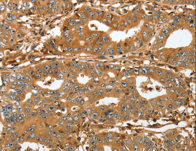 RAP1A Antibody - Immunohistochemistry of paraffin-embedded Human lung cancer using RAP1A Polyclonal Antibody at dilution of 1:45.