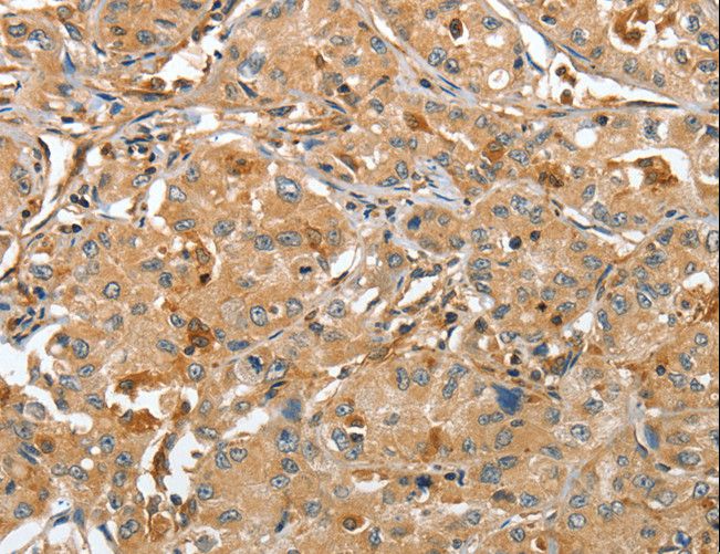 RAP1A Antibody - Immunohistochemistry of paraffin-embedded Human lung cancer using RAP1A Polyclonal Antibody at dilution of 1:45.