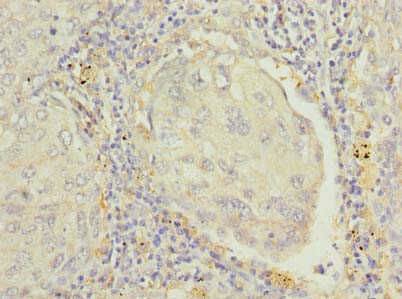 RAP1B Antibody - Immunohistochemistry of paraffin-embedded human lung cancer using antibody at dilution of 1:100.