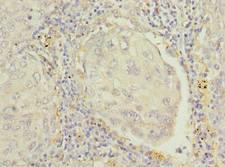RAP1B Antibody - Immunohistochemistry of paraffin-embedded human lung cancer using antibody at dilution of 1:100.