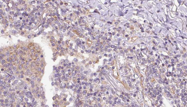 RAP1B Antibody - 1:100 staining human lymph carcinoma tissue by IHC-P. The sample was formaldehyde fixed and a heat mediated antigen retrieval step in citrate buffer was performed. The sample was then blocked and incubated with the antibody for 1.5 hours at 22°C. An HRP conjugated goat anti-rabbit antibody was used as the secondary.