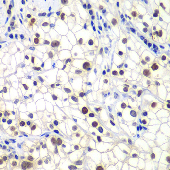 RAP30 / GTF2F2 Antibody - Immunohistochemistry of paraffin-embedded human kidney cancer tissue.