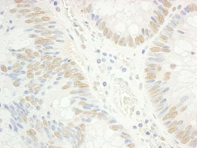 RAP74 / GTF2F1 Antibody - Detection of Human RAP74 by Immunohistochemistry. Sample: FFPE section of human colon carcinoma. Antibody: Affinity purified rabbit anti-RAP74 used at a dilution of 1:5000 (0.2 ug/ml). Detection: DAB.