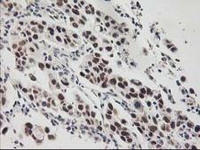 RAP74 / GTF2F1 Antibody - IHC of paraffin-embedded Carcinoma of Human lung tissue using anti-GTF2F1 mouse monoclonal antibody.