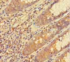 RAP74 / GTF2F1 Antibody - Immunohistochemistry of paraffin-embedded human colon cancer at dilution of 1:100