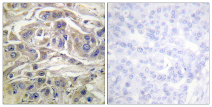 RAPGEF1 Antibody - Immunohistochemistry analysis of paraffin-embedded human breast carcinoma, using RapGEF1 Antibody. The picture on the right is blocked with the synthesized peptide.