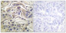 RAPGEF1 Antibody - Immunohistochemistry analysis of paraffin-embedded human breast carcinoma, using RapGEF1 Antibody. The picture on the right is blocked with the synthesized peptide.