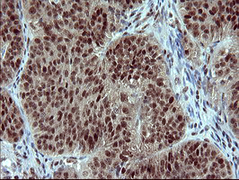 RAPGEF1 Antibody - IHC of paraffin-embedded Adenocarcinoma of Human ovary tissue using anti-RAPGEF1 mouse monoclonal antibody. (Heat-induced epitope retrieval by 10mM citric buffer, pH6.0, 120°C for 3min).