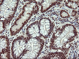 RAPGEF1 Antibody - IHC of paraffin-embedded Adenocarcinoma of Human colon tissue using anti-RAPGEF1 mouse monoclonal antibody. (Heat-induced epitope retrieval by 10mM citric buffer, pH6.0, 120°C for 3min).