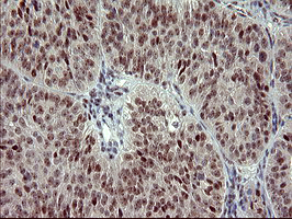 RAPGEF1 Antibody - IHC of paraffin-embedded Adenocarcinoma of Human ovary tissue using anti-RAPGEF1 mouse monoclonal antibody. (Heat-induced epitope retrieval by 10mM citric buffer, pH6.0, 120°C for 3min).