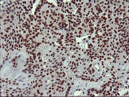 RAPGEF1 Antibody - IHC of paraffin-embedded Carcinoma of Human thyroid tissue using anti-RAPGEF1 mouse monoclonal antibody. (Heat-induced epitope retrieval by 10mM citric buffer, pH6.0, 120°C for 3min).