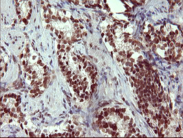 RAPGEF1 Antibody - IHC of paraffin-embedded Carcinoma of Human prostate tissue using anti-RAPGEF1 mouse monoclonal antibody. (Heat-induced epitope retrieval by 10mM citric buffer, pH6.0, 120°C for 3min).