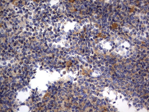RAPGEF1 Antibody - Immunohistochemical staining of paraffin-embedded Human lymphoma tissue using anti-RAPGEF1 mouse monoclonal antibody.  heat-induced epitope retrieval by 1 mM EDTA in 10mM Tris, pH8.0, 120C for 3min)