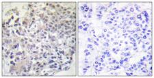RAPGEF1 Antibody - Peptide - + Immunohistochemistry analysis of paraffin-embedded human breast carcinoma tissue using RapGEF1 antibody.