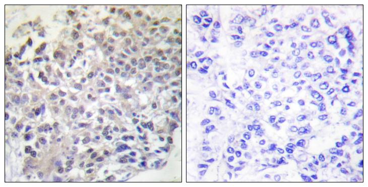 RAPGEF1 Antibody - Peptide - + Immunohistochemistry analysis of paraffin-embedded human breast carcinoma tissue using RapGEF1 antibody.