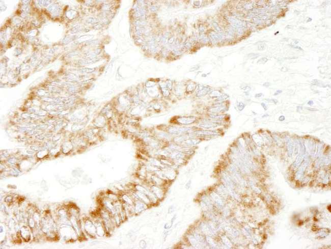 RAPGEF2 Antibody - Detection of Human PDZ-GEF1 by Immunohistochemistry. Sample: FFPE section of human lung adenocarcinoma. Antibody: Affinity purified rabbit anti-PDZ-GEF1 used at a dilution of 1:250. Epitope Retrieval Buffer-High pH (IHC-101J) was substituted for Epitope Retrieval Buffer-Reduced pH.