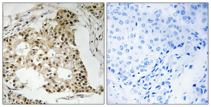 RARA / RAR Alpha Antibody - Immunohistochemistry analysis of paraffin-embedded human breast carcinoma, using Retinoic Acid Receptor alpha (Phospho-Ser77) Antibody. The picture on the right is blocked with the phospho peptide.