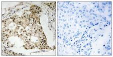 RARA / RAR Alpha Antibody - Immunohistochemistry analysis of paraffin-embedded human breast carcinoma, using Retinoic Acid Receptor alpha (Phospho-Ser77) Antibody. The picture on the right is blocked with the phospho peptide.