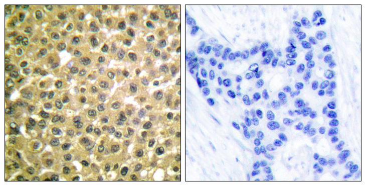 RARB / RAR Beta Antibody - Immunohistochemistry analysis of paraffin-embedded human breast carcinoma tissue, using Retinoic Acid Receptor beta Antibody. The picture on the right is blocked with the synthesized peptide.