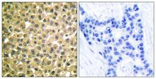 RARB / RAR Beta Antibody - Immunohistochemistry analysis of paraffin-embedded human breast carcinoma tissue, using Retinoic Acid Receptor beta Antibody. The picture on the right is blocked with the synthesized peptide.