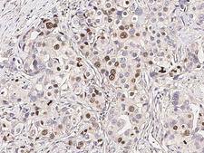 RARB / RAR Beta Antibody - Immunochemical staining RARB in human breast carcinoma with rabbit polyclonal antibody (1:1000, formalin-fixed paraffin embedded sections).