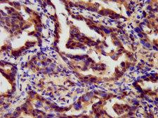 RARG / RAR-Gamma Antibody - Immunohistochemistry image at a dilution of 1:300 and staining in paraffin-embedded human lung cancer performed on a Leica BondTM system. After dewaxing and hydration, antigen retrieval was mediated by high pressure in a citrate buffer (pH 6.0) . Section was blocked with 10% normal goat serum 30min at RT. Then primary antibody (1% BSA) was incubated at 4 °C overnight. The primary is detected by a biotinylated secondary antibody and visualized using an HRP conjugated SP system.