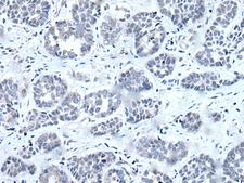 RARG / RAR-Gamma Antibody - Immunohistochemistry of paraffin-embedded Human esophagus cancer tissue  using RARG Polyclonal Antibody at dilution of 1:55(×200)
