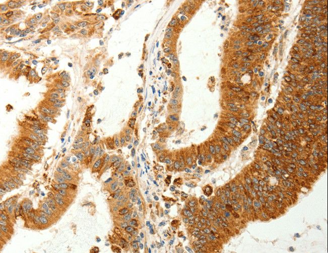 RARRES1 Antibody - Immunohistochemistry of paraffin-embedded Human colon cancer using RARRES1 Polyclonal Antibody at dilution of 1:60.