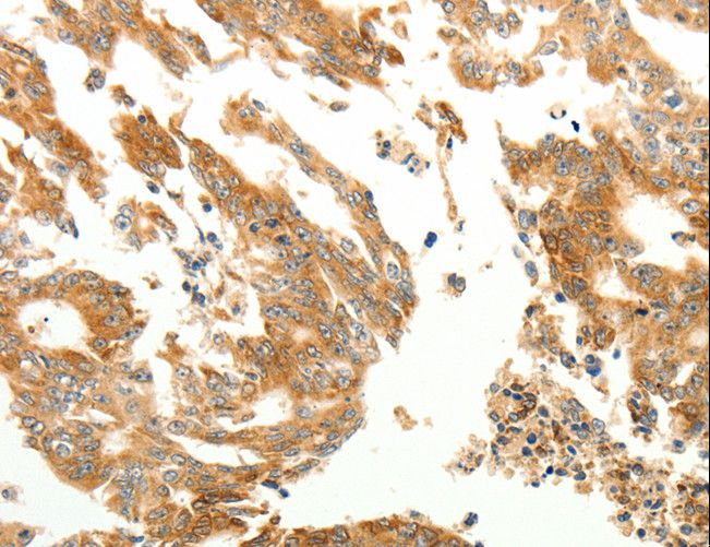 RARRES1 Antibody - Immunohistochemistry of paraffin-embedded Human gastric cancer using RARRES1 Polyclonal Antibody at dilution of 1:60.
