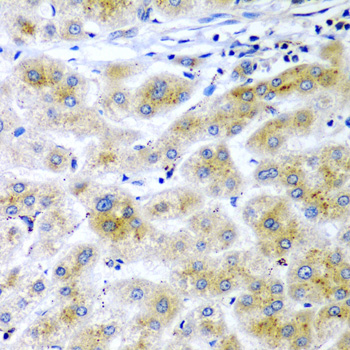 RARRES2 / Chemerin Antibody - Immunohistochemistry of paraffin-embedded human liver cancer tissue.