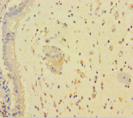 RARRES3 Antibody - Immunohistochemistry of paraffin-embedded human lung cancer using RARRES3 Antibody at dilution of 1:100
