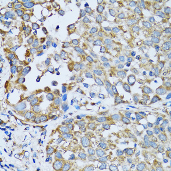 RARS Antibody - Immunohistochemistry of paraffin-embedded human lung cancer tissue.