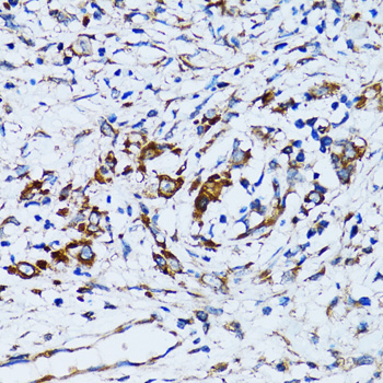 RARS Antibody - Immunohistochemistry of paraffin-embedded human uterine cancer tissue.