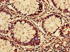 RARS Antibody - Immunohistochemistry of paraffin-embedded human colon cancer using RARS Antibody at dilution of 1:100