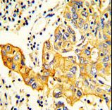 RARS2 / ARGRS Antibody - Formalin-fixed and paraffin-embedded human Lung carcinoma reacted with RARS2 Antibody , which was peroxidase-conjugated to the secondary antibody, followed by DAB staining. This data demonstrates the use of this antibody for immunohistochemistry; clinical relevance has not been evaluated.