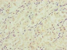 RARS2 / ARGRS Antibody - Immunohistochemistry of paraffin-embedded human gastric cancer at dilution of 1:100