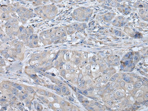 RASA1 Antibody - Immunohistochemistry of paraffin-embedded Human breast cancer tissue  using RASA1 Polyclonal Antibody at dilution of 1:40(×200)