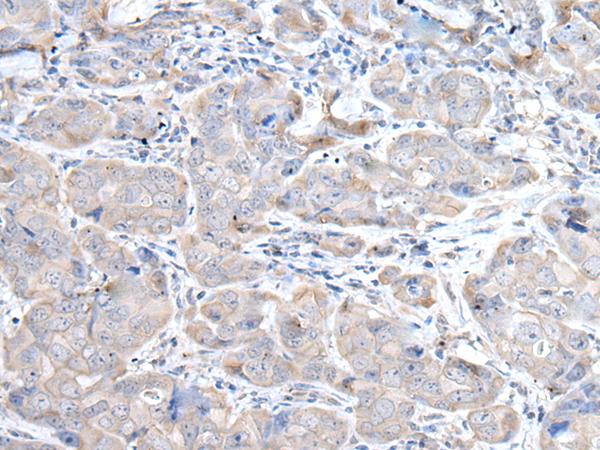 RASA1 Antibody - Immunohistochemistry of paraffin-embedded Human breast cancer tissue  using RASA1 Polyclonal Antibody at dilution of 1:45(×200)